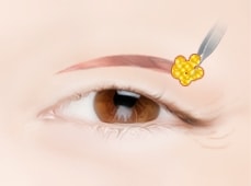 상안검 성형술 STEP 02