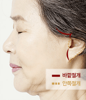 VIP Extended Deep Plane 얼굴리프팅 수술방법 CASE01