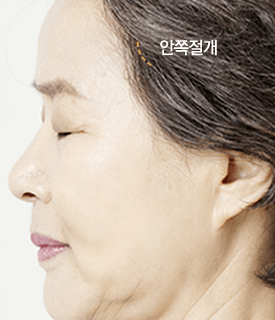 VIP 템플리프팅(관자놀이거상술) 수술방법 CASE01