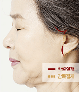 VIP 최소절개 얼굴리프팅 수술방법 CASE01