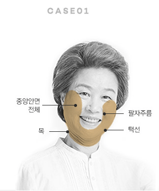 수술방법에 따른 효과의 차이