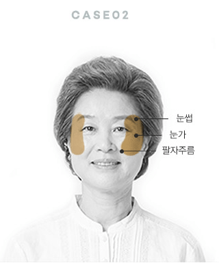 수술방법에 따른 효과의 차이