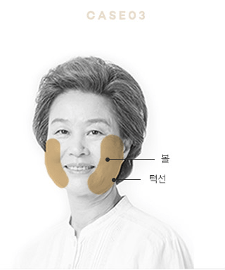 수술방법에 따른 효과의 차이