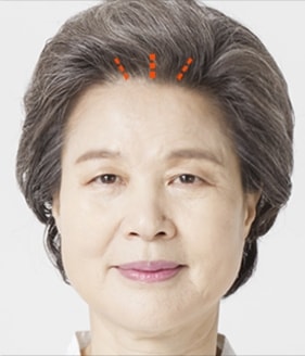 VIP 내시경 이마리프팅 수술방법 SETP01