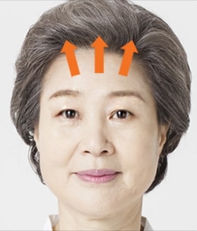 VIP 내시경 이마리프팅 수술방법 STEP03