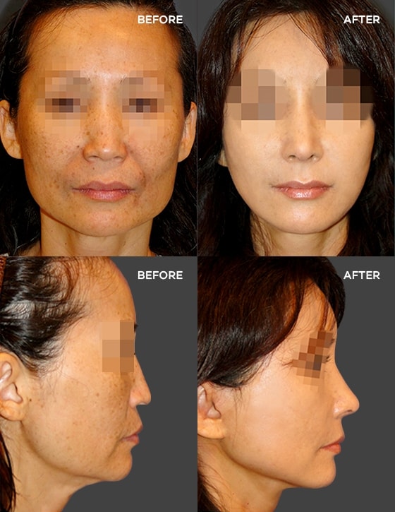 Anti-Aging 실제수술사례 BEFORE  AFTER