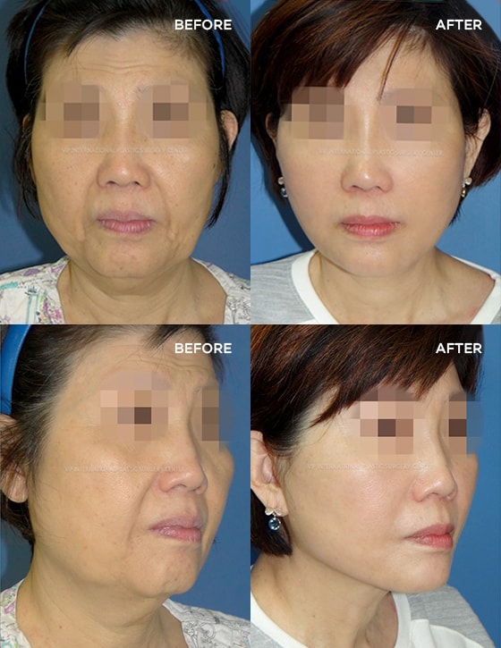 Anti-Aging 실제수술사례 BEFORE  AFTER