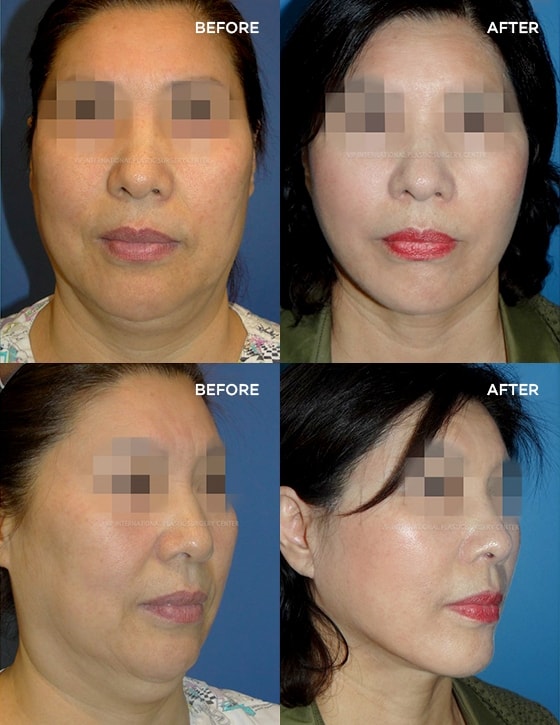 Anti-Aging 실제수술사례 BEFORE  AFTER