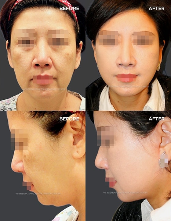Anti-Aging 실제수술사례 BEFORE  AFTER