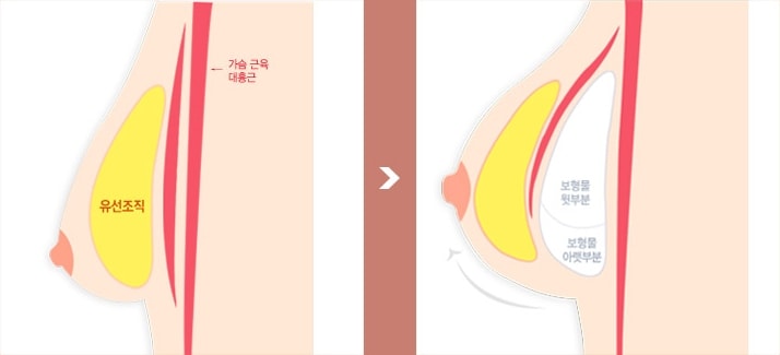 수유 후 가슴확대 수술방법