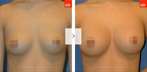 VIP성형외과 가슴수술사례