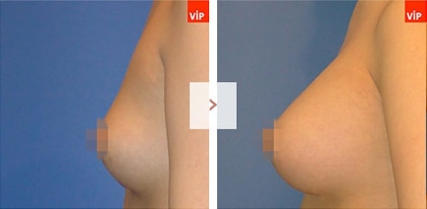 VIP성형외과 가슴수술사례