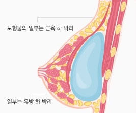 01 이중평면법