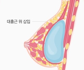 02 유선하 삽입법