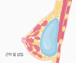 03 근막 밑 삽입