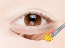 매몰법 STEP 02