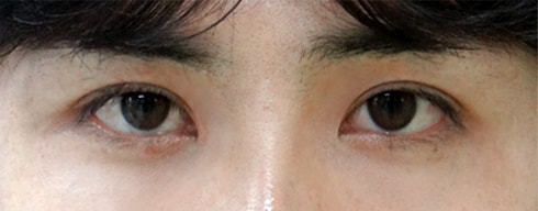 결과로 증명하는 VIP 트임성형