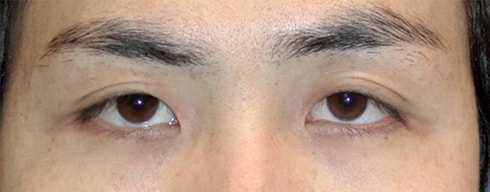 결과로 증명하는 VIP 트임성형
