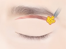눈썹 리프팅 STEP 02