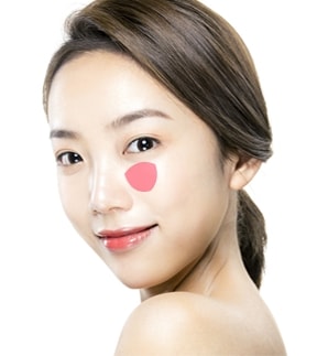 VIP 광대확대수술방법