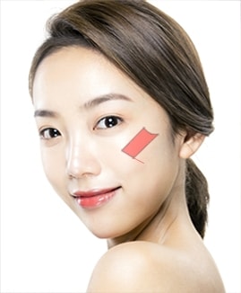 VIP 광대축소수술 STEP 01