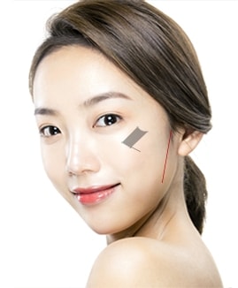 VIP 광대축소수술 STEP 03
