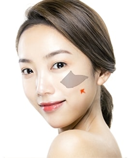 VIP 광대축소수술 STEP 04