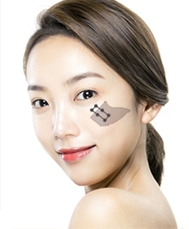 VIP 광대축소수술 STEP 05