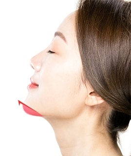 앞턱전진술 수술방법 STEP 02