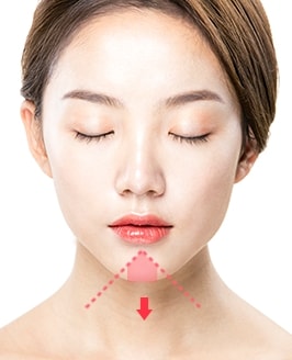 앞턱절골술 수술방법 STEP 01