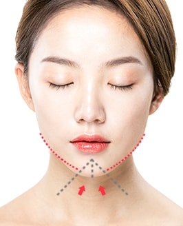 앞턱절골술 수술방법 STEP 02
