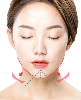 앞턱절골술 수술방법 STEP 03
