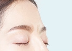 미간필러
