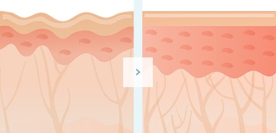 오메가리프팅 시술전 / 후