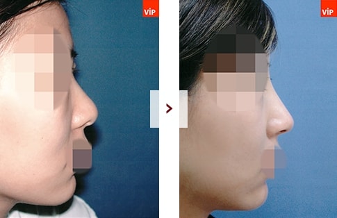 결과로 증명하는 VIP 코성형