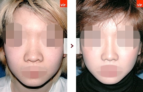 결과로 증명하는 VIP 코성형