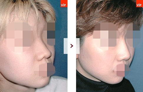 결과로 증명하는 VIP 코성형