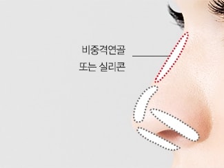 셀럽코성형 수술방법 STEP02