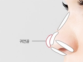 셀럽코성형 수술방법 STEP03