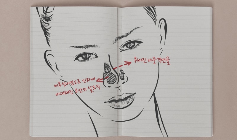 비중격만곡증이란 무엇인지 설명